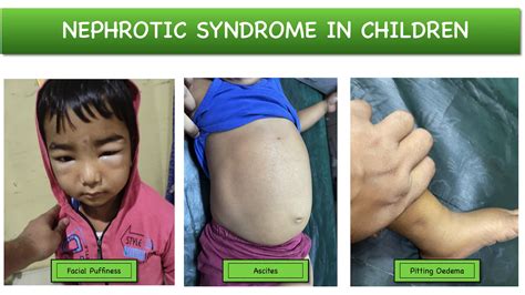 Nephrotic syndrome .